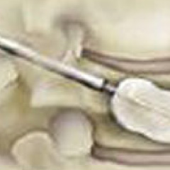 Carousel Vertebroplasty